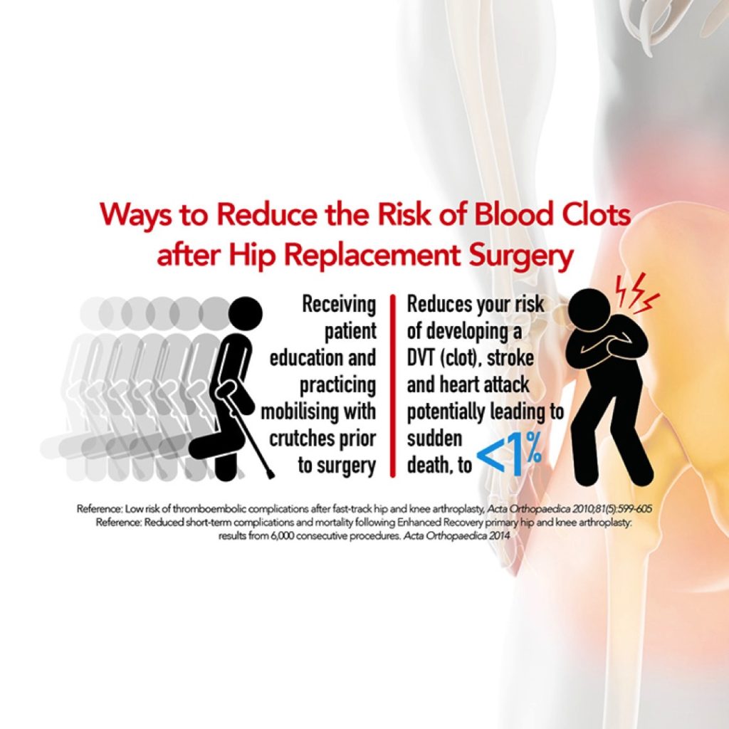 Sex After Hip Replacement?